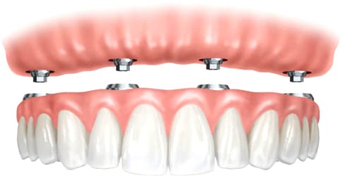 Chirurgia pre-protesica con impianti dentali