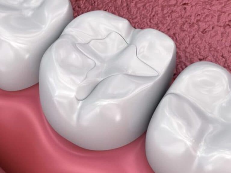 Prevenzione e sigillature dentali