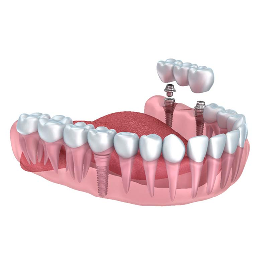 Impianti dentali su arcata completa